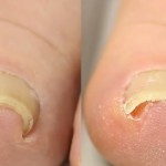 ついに出た!巻き爪がたった30分で治る矯正器具