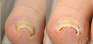 ついに出た！巻き爪がたった30分で治る矯正器具