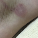 ただの虫刺されだと思って侮るな!→こんな場合は直ちに病院へ!