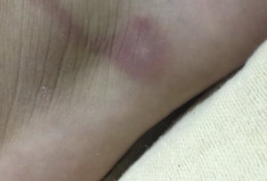 ただの虫刺されだと思って侮るな！→こんな場合は直ちに病院へ！