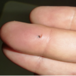 刺さったトゲが中々抜けない・・・。そんな時の驚くほど簡単な対処法が話題に!!