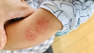 全国のパパママに届け！1歳ぐらいの子どもに多い原因不明の病気。こんな症状があったら迷わず病院へ行って欲しい！