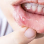 口内炎ができた時の最強の対処法が判明!「これ知れただけで最高の一年だった。」