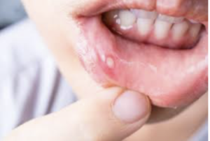 口内炎ができた時の最強の対処法が判明！「これ知れただけで最高の一年だった。」