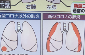 今一度確認しておきたい。『肺炎』と『新型コロナ』の違いがわかりやすいと話題に。「こう見ると改めてヤバさが分かる」