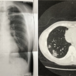 コロナ闘病中の男性が貴重な情報をSNSに共有。「この情報はめちゃくちゃ大事！」