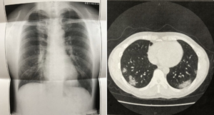 コロナ闘病中の男性が貴重な情報をSNSに共有。「この情報はめちゃくちゃ大事！」
