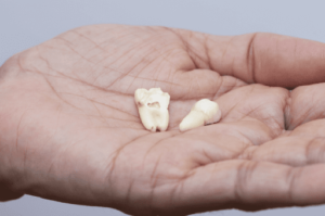 歯科医師が注意喚起！事故によって歯が抜けた時『絶対にやらないで欲しいこと』なぜなら・・・