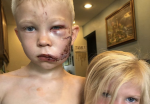 ４歳の妹に突進する犬の間に立ち塞がって守った６歳のブリッシャー君。９０針も縫う大怪我を負いながら、父からのなぜ間に入ったのかとの回答に痺れる。