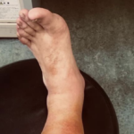 被災地にて長靴を履かずに浸水場所で作業をした結果・・・→経験者が注意喚起を促しています!