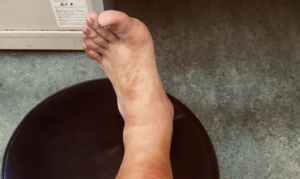 被災地にて長靴を履かずに浸水場所で作業をした結果・・・→経験者が注意喚起を促しています！