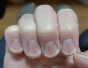 １年間爪をケアし続けた結果・・・ビフォーアフターに衝撃の声！「爪の形変えられるの初めて知った ・・・」