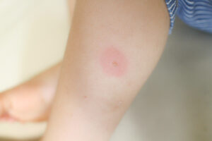 【マジで蚊に刺されなくなる必殺技】去年虫に刺されまくった娘が『あること』をするだけで全く刺されなくなった！→これは広まるべき神業！！