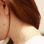 美容外科でホクロを取ろうと考えている人は・・・医師が呼びかける『注意すべきこと』