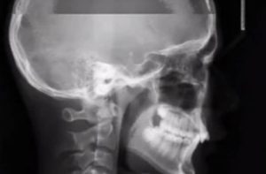 すごい（笑）レントゲンの撮影中にくしゃみをした結果・・・