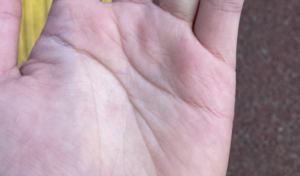 「なんか薬指の血管死んでる」写真を見てみたら・・えぇっ！？何これ。