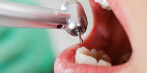 『ドクターに言われた衝撃的な言葉』差し歯が取れた・歯が折れたと受診した患者に一番多い理由はまさかの・・・